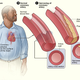 Illustration for article titled What we know now about cholesterol that we didnt 10 years ago
